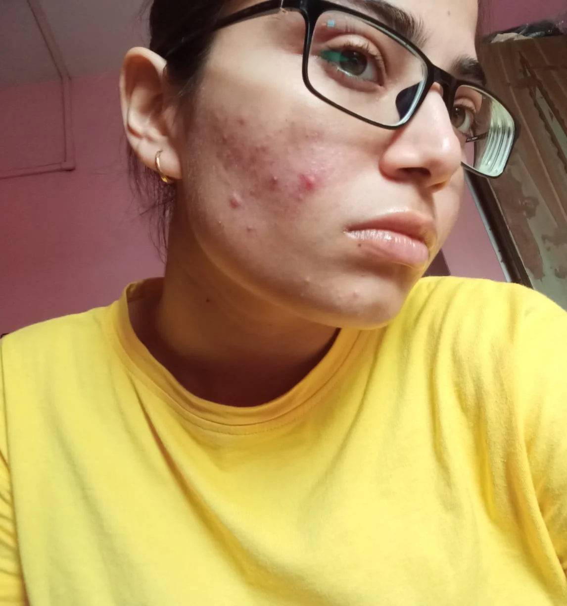 Annanya's skin covered with acne (August 2018)