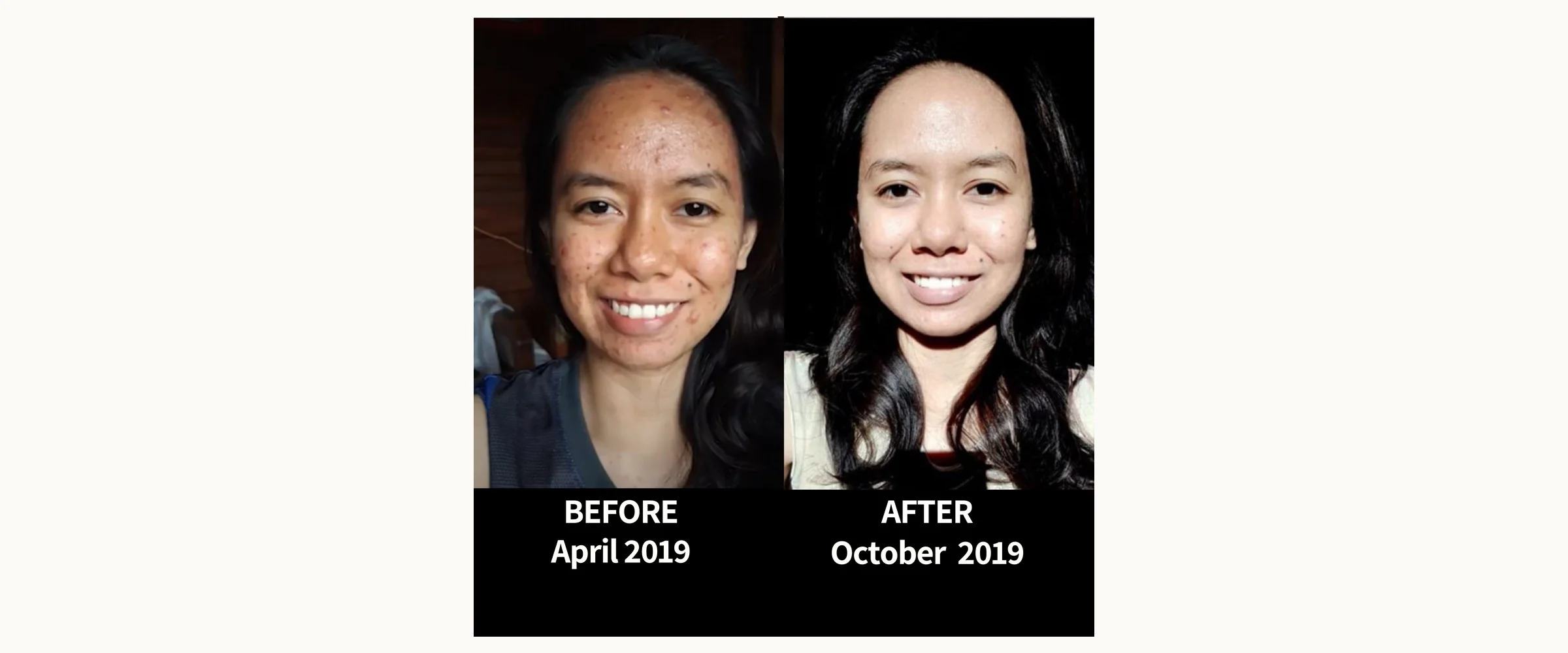 Ruffa's experience with PCOS, acne and hair fall on the Satvic lifestyle