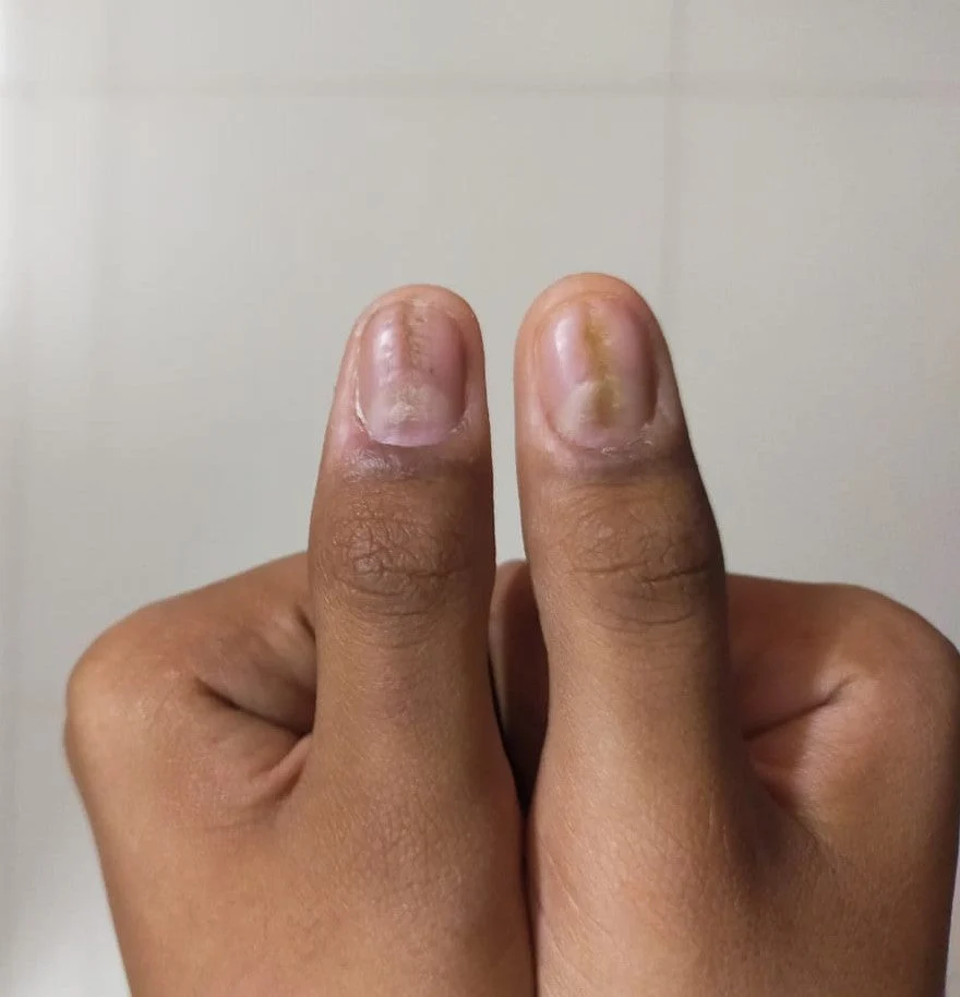 Vidhi's nails before and after following the Satvic Lifestyle